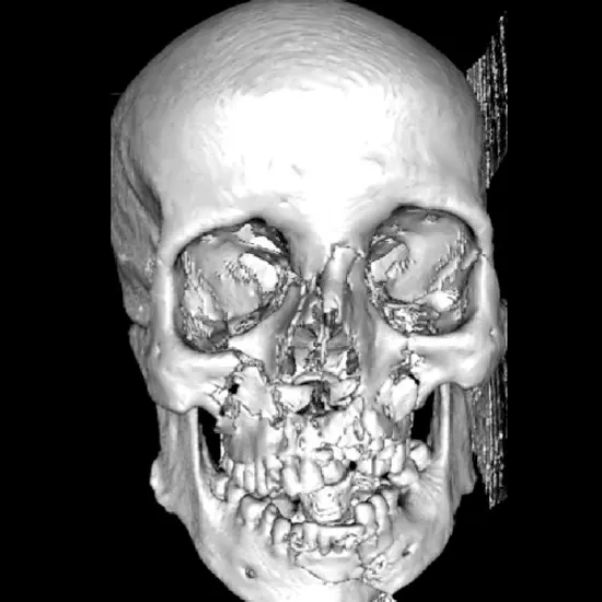 3D CT PNS Reconstruction